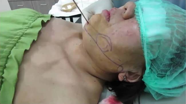 liposuction surgery